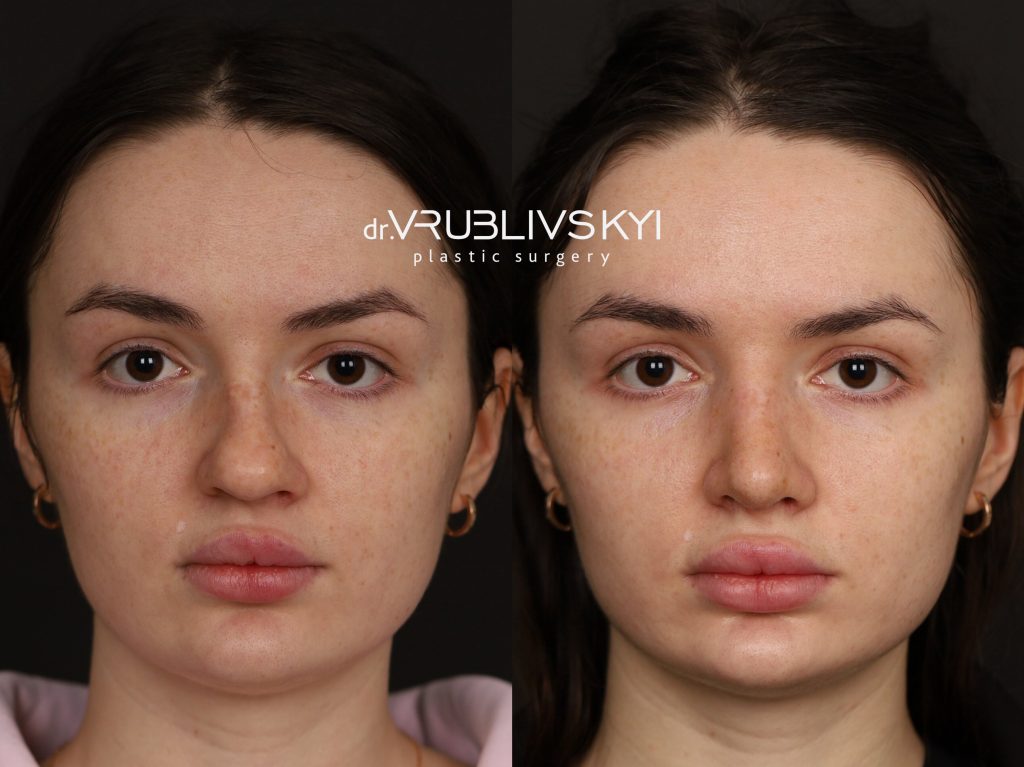 Ринопластика до та після, фронтальна проєкція