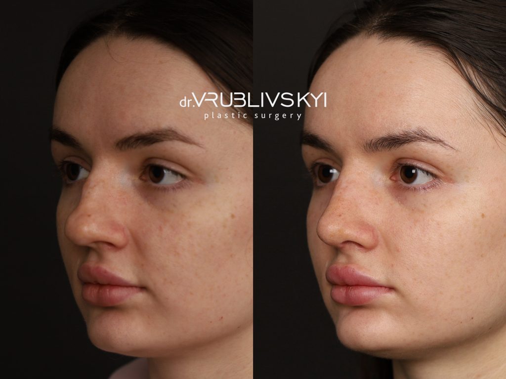 Ринопластика до та після, коса проєкція