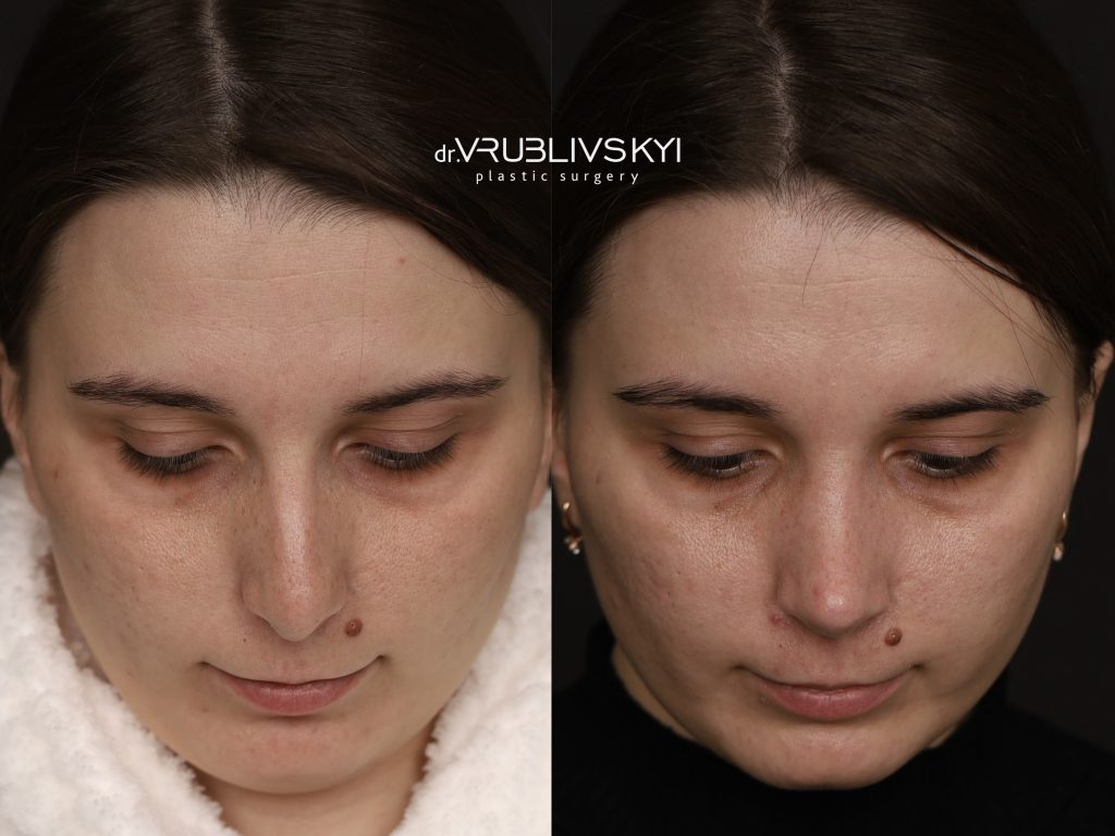 Ринопластика до та після, погляд вниз