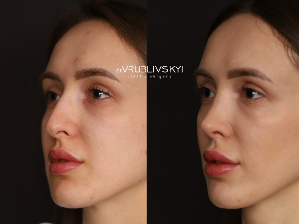 Ринопластика до та після, коса проєкція
